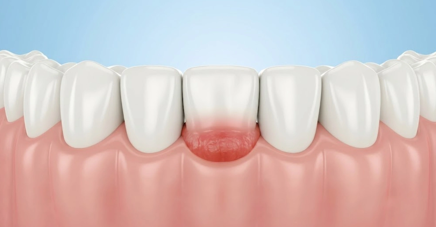 What Bacteria Causes Periodontitis inblog